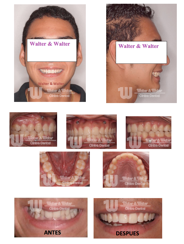 Cómo DEFINIR tu mandíbula Rápido, sin Cirugía y sin Dañar tus Dientes😲? 