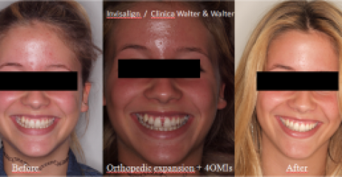Paladar estrecho y recesiones gingivales en maxilar (edad 16 años)