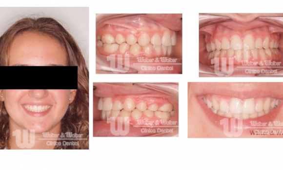 SMILE ÉTROITE