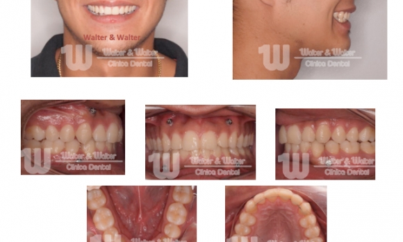 ADVANCE SURGICAL MANDIBULAR